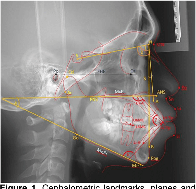 Cephalometric analysis for dentistry